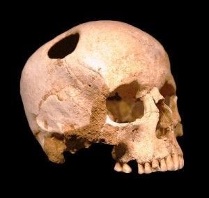 Girl skull, trepanated with flint tools; neolithic from Lausanne Natural History Museum. Photograph by Rama, Wikimedia Commons, Cc-by-sa-2.0-fr